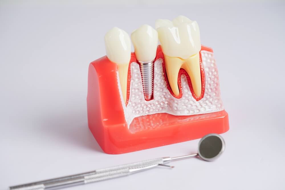 How to Choose the Right Dentist for Your Dental Implants