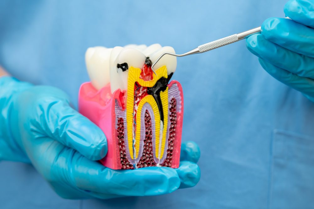 Can Root Canal Treatment Fix Recurrent Tooth Infections?